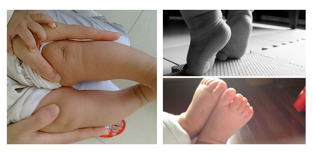 小孩肌张力增高(小儿尖足)该不该治疗