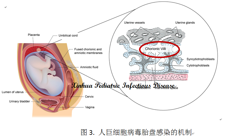 生命早期的人鉅細胞病毒感染一