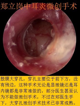 前言:中耳炎微創手術是目前治療慢性化膿性中耳炎及膽脂瘤型中耳炎最