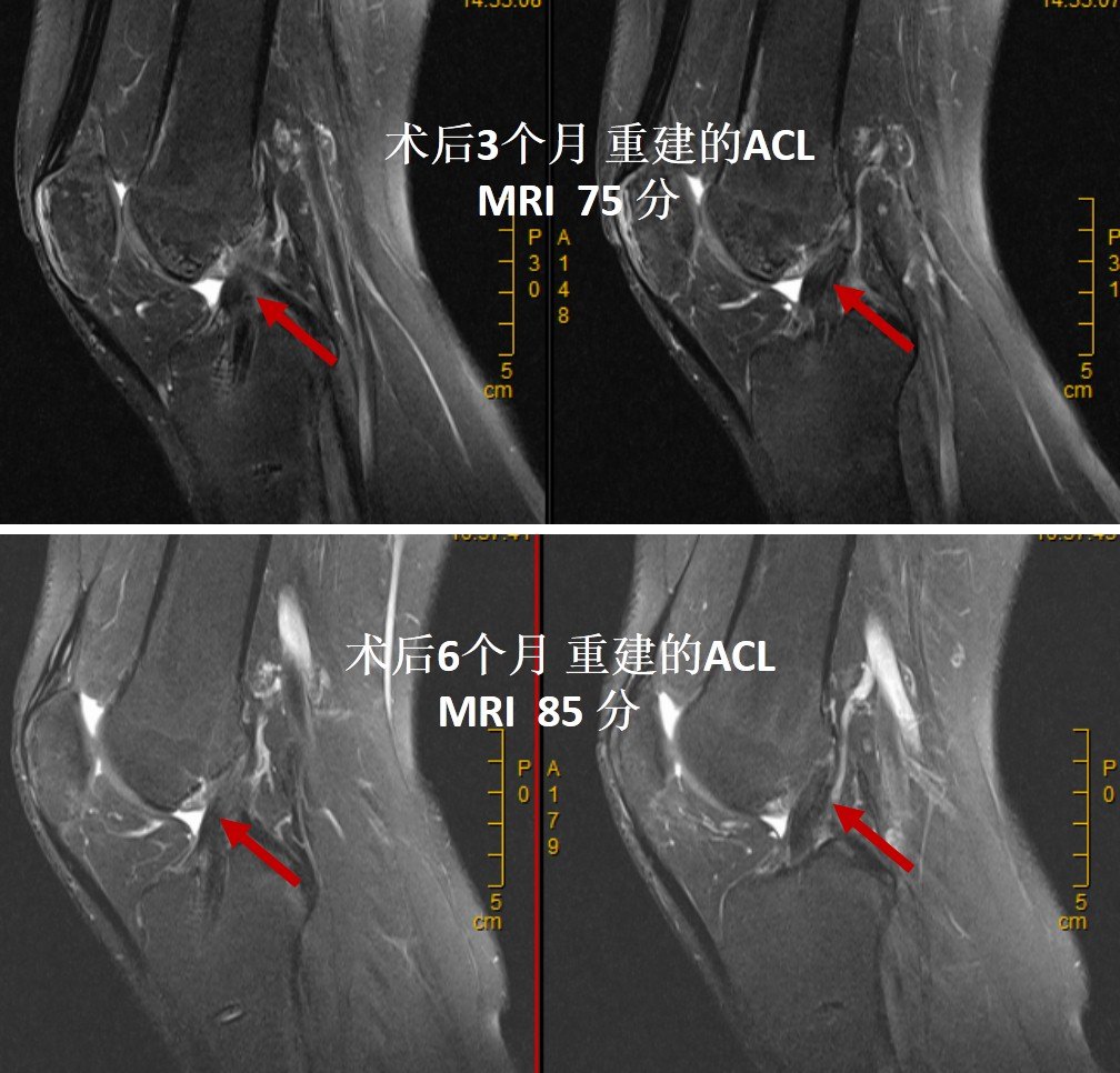做完前交叉韧带 Acl 重建手术后韧带 变 啥样 Vk32