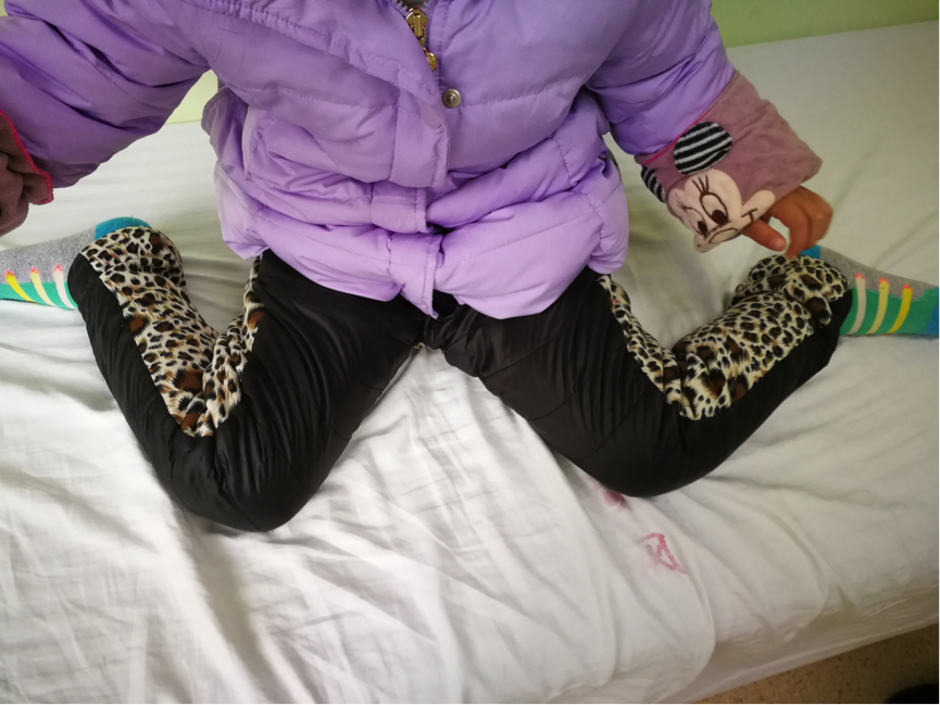 孩子走路内八字怎么办