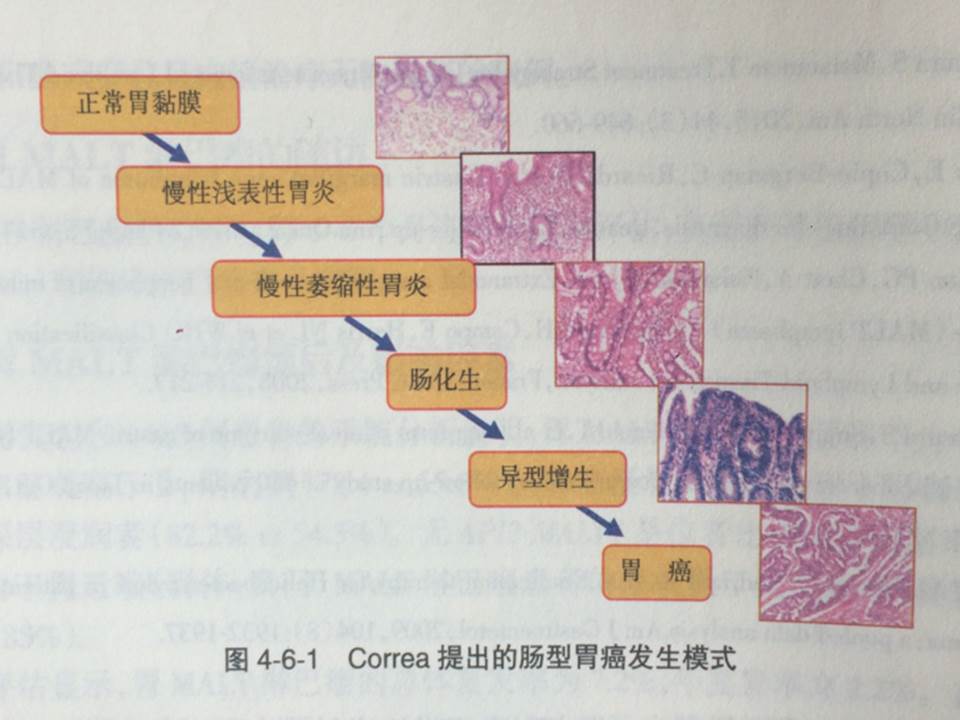 幽门螺杆菌和胃癌的关系?