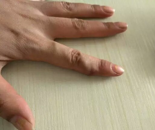 一例动静脉血管瘤诊疗 - 好大夫在线