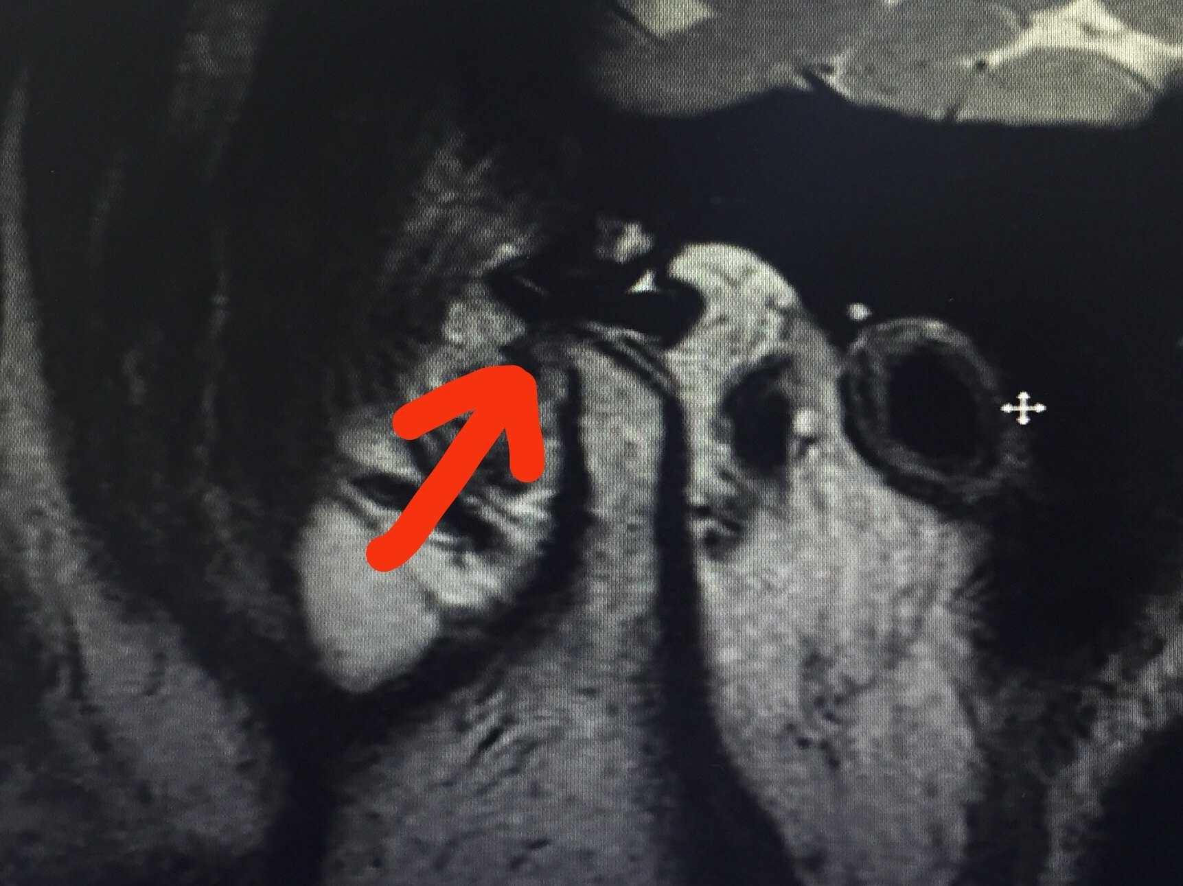 张口受限不可复关节盘前移位不用开刀也能复位 - 好大夫在线