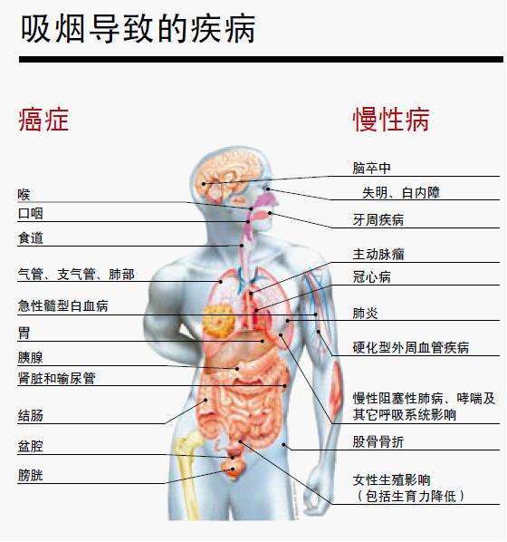 肺癌成为肿瘤中第一杀手