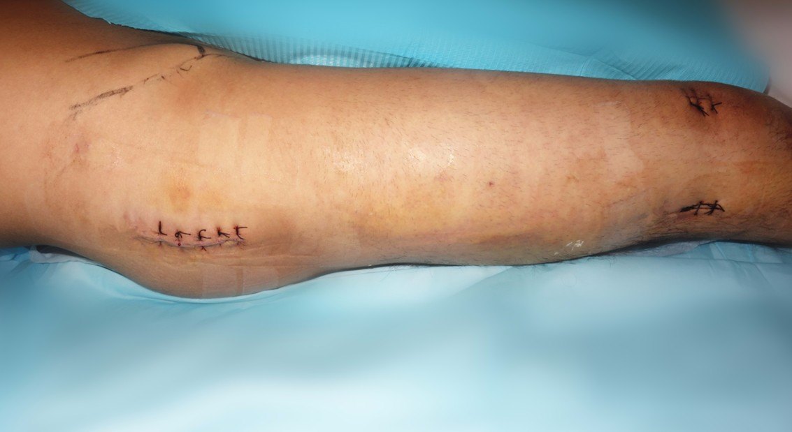 大腿骨折微创手术图片图片