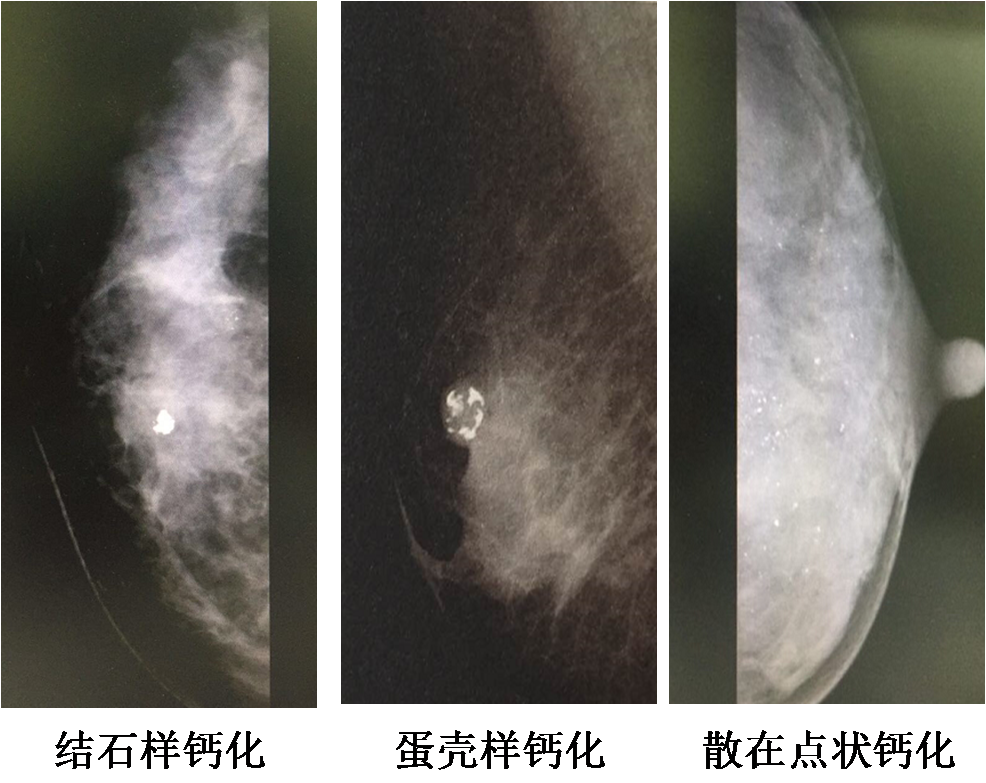 乳腺4a类一般良性 钙化图片