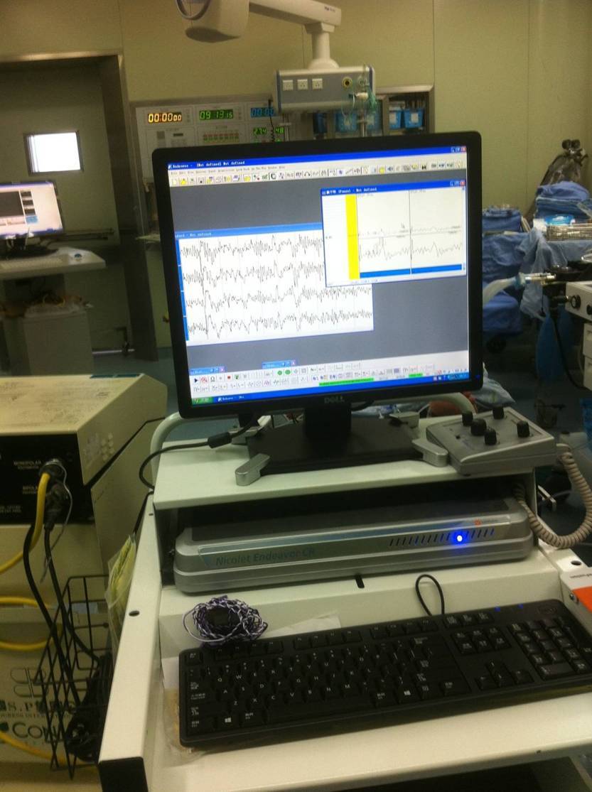 颈动脉狭窄的手术治疗