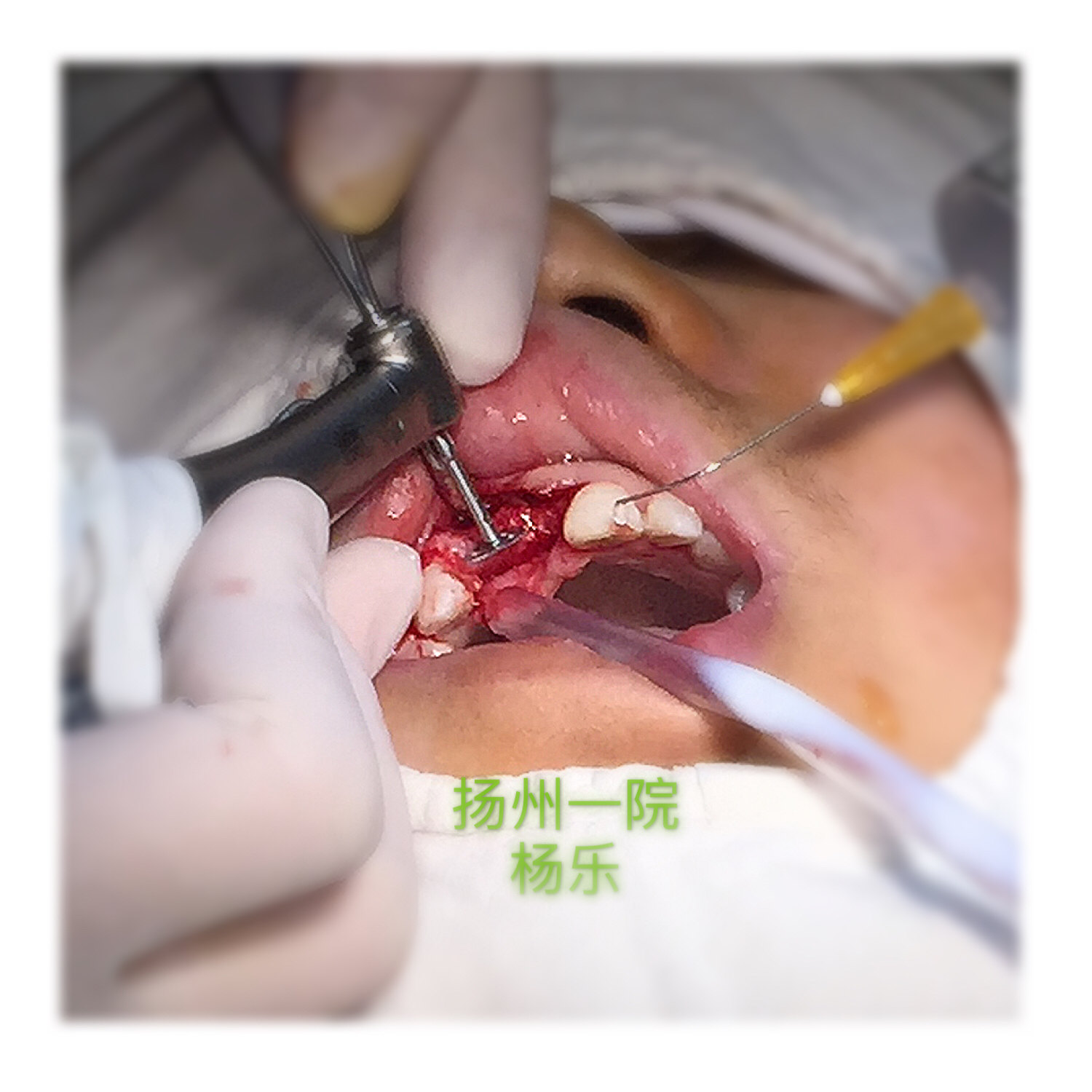 上前牙外伤缺失唇侧骨壁凹陷,种植术中行骨襞开增加丰满度.