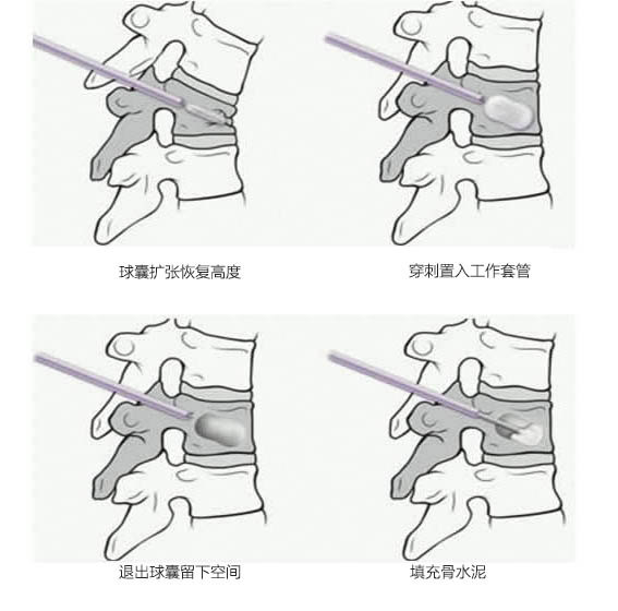 椎体成形治疗脊柱骨质疏松性压缩性骨折