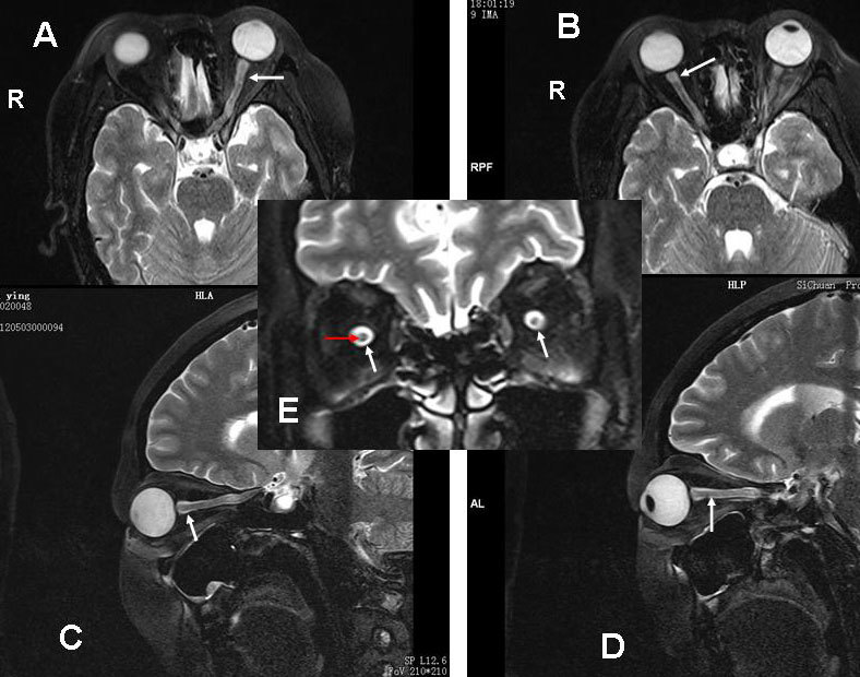 颅内高压的典型表双侧视乳头水肿mri球后视神经鞘扩张