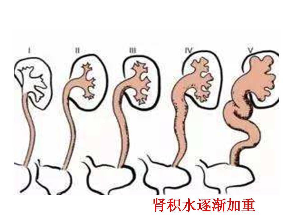 膀胱逼尿肌无力的诊治 - 好大夫在线