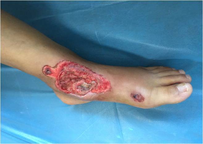 足踝部皮肤软组织缺损的修复 - 好大夫在线