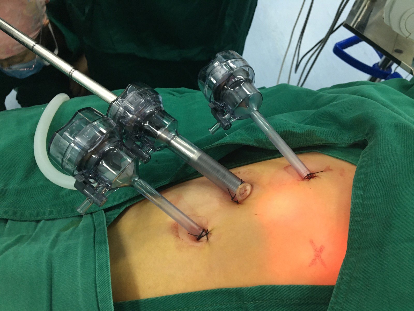 隐睾手术过程图片