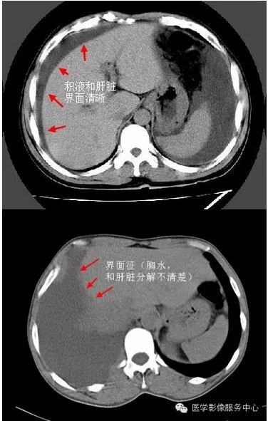 鉴别胸腹水需牢记这四个征象