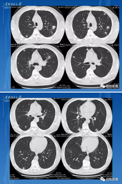 韦格纳肉芽肿肺部影像图片