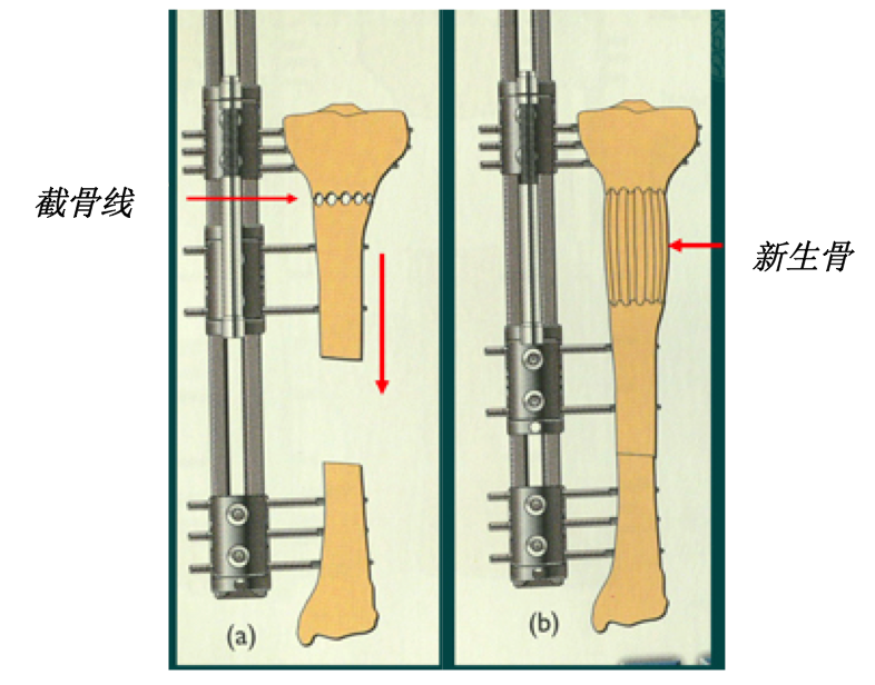 骨搬移手术原理图图片