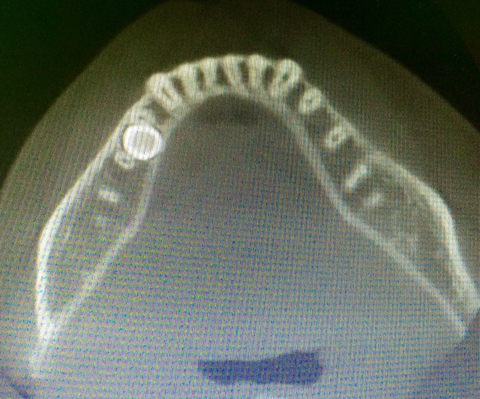 一例下颌埋伏牙舌侧开窗手术 - 好大夫在线