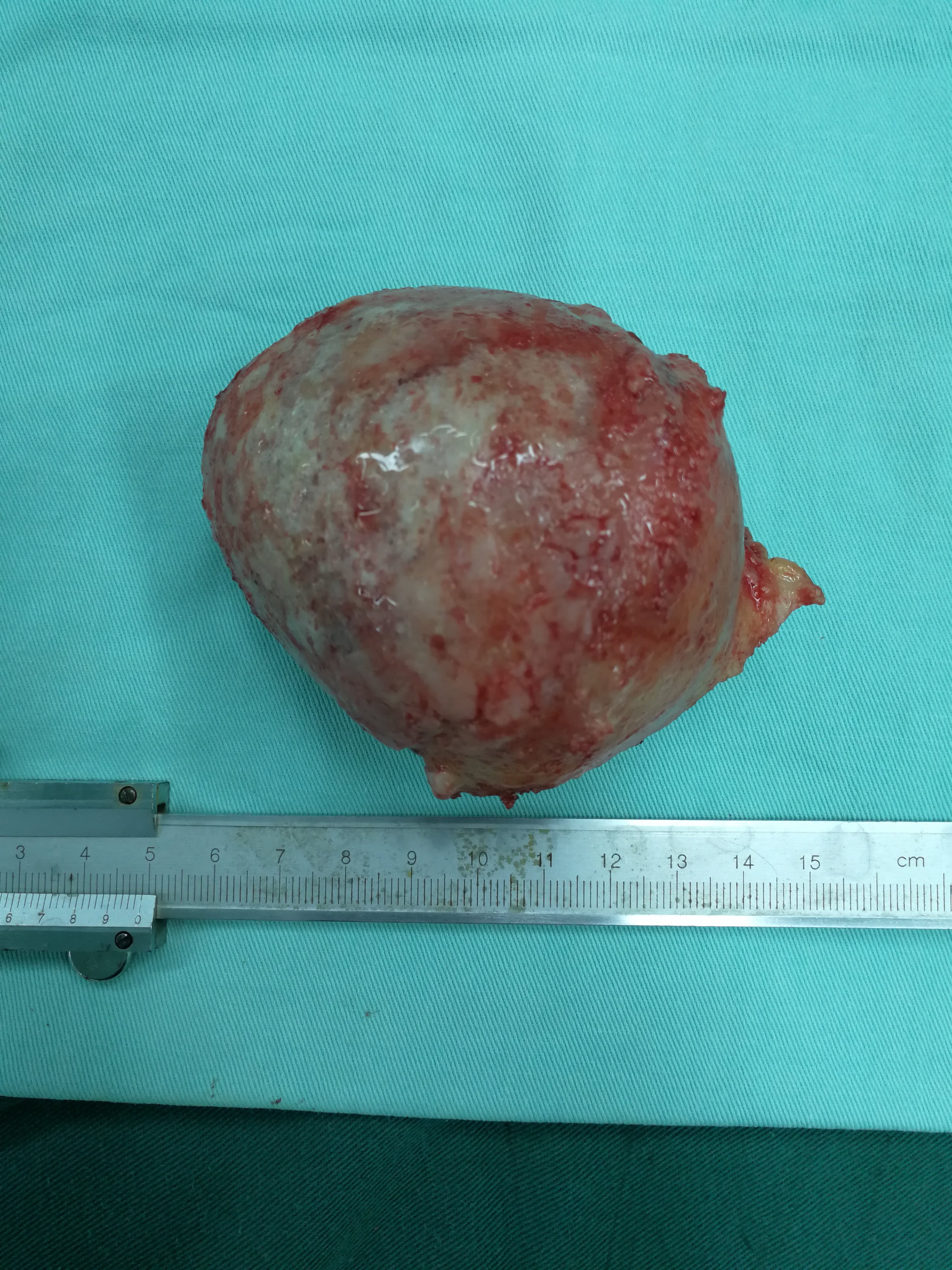 股骨头坏死片子不严重你会想到实际取下股骨头变这样吗