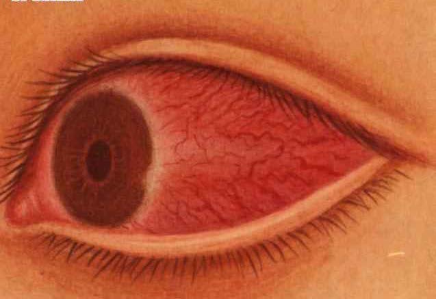 虹膜炎急性期的眼睛红表现为睫状充血,常出现眼痛,畏光,房水混浊,虹膜