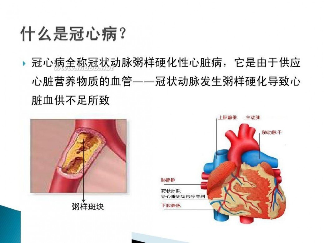 带您了解冠状动脉粥样硬化性心脏病