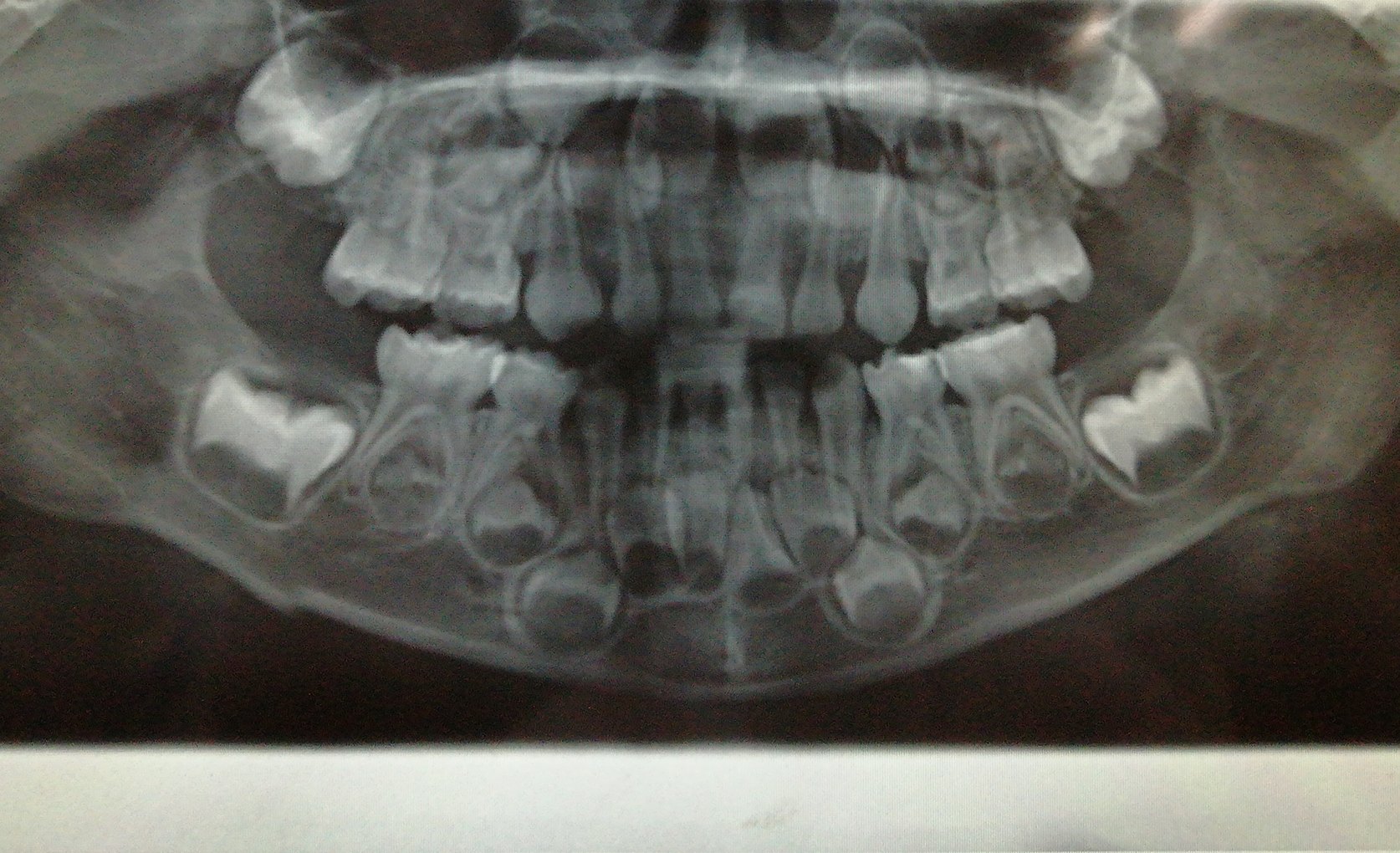 乳牙x光照图片