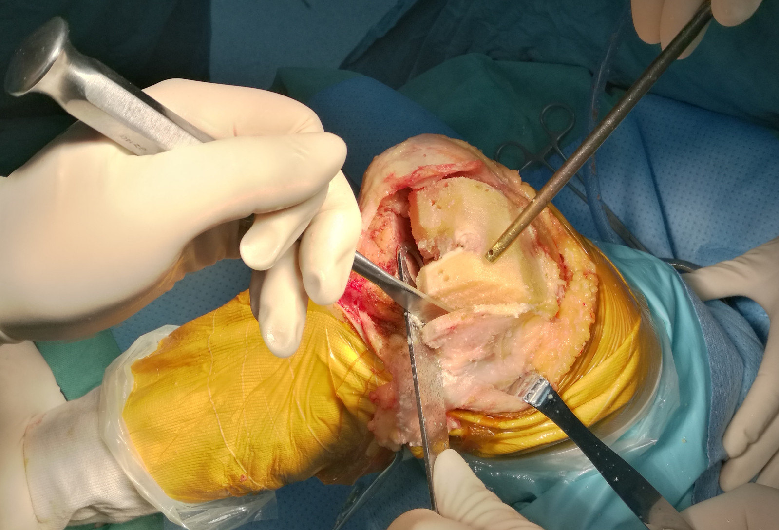 膝外翻畸形tka:股骨外髁滑移截骨技术 - 好大夫在线