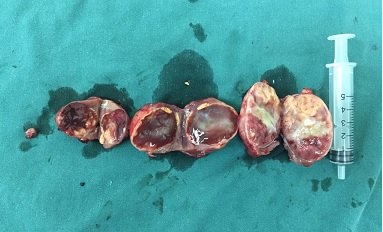 一例疑难的双侧多发肾癌用零缺血保肾方法切除