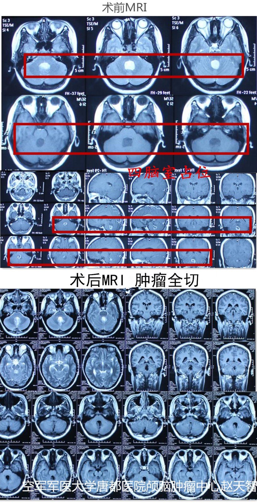 唐都颅脑肿瘤专家赵天智,精湛医术除四脑室胶质瘤 