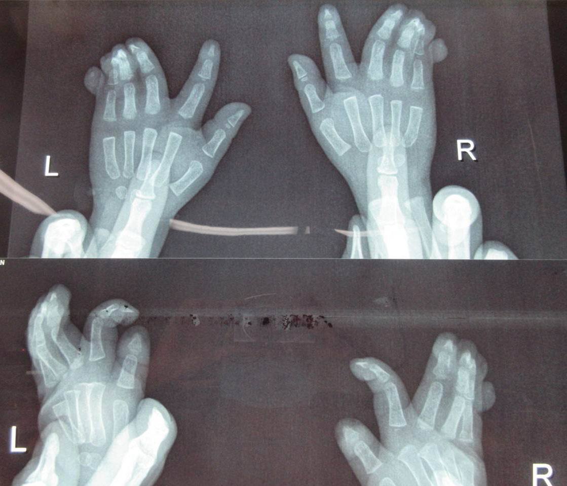 术前x线片:患儿,男,1岁3个月,家属在患儿出生时发现双手并指多指畸形
