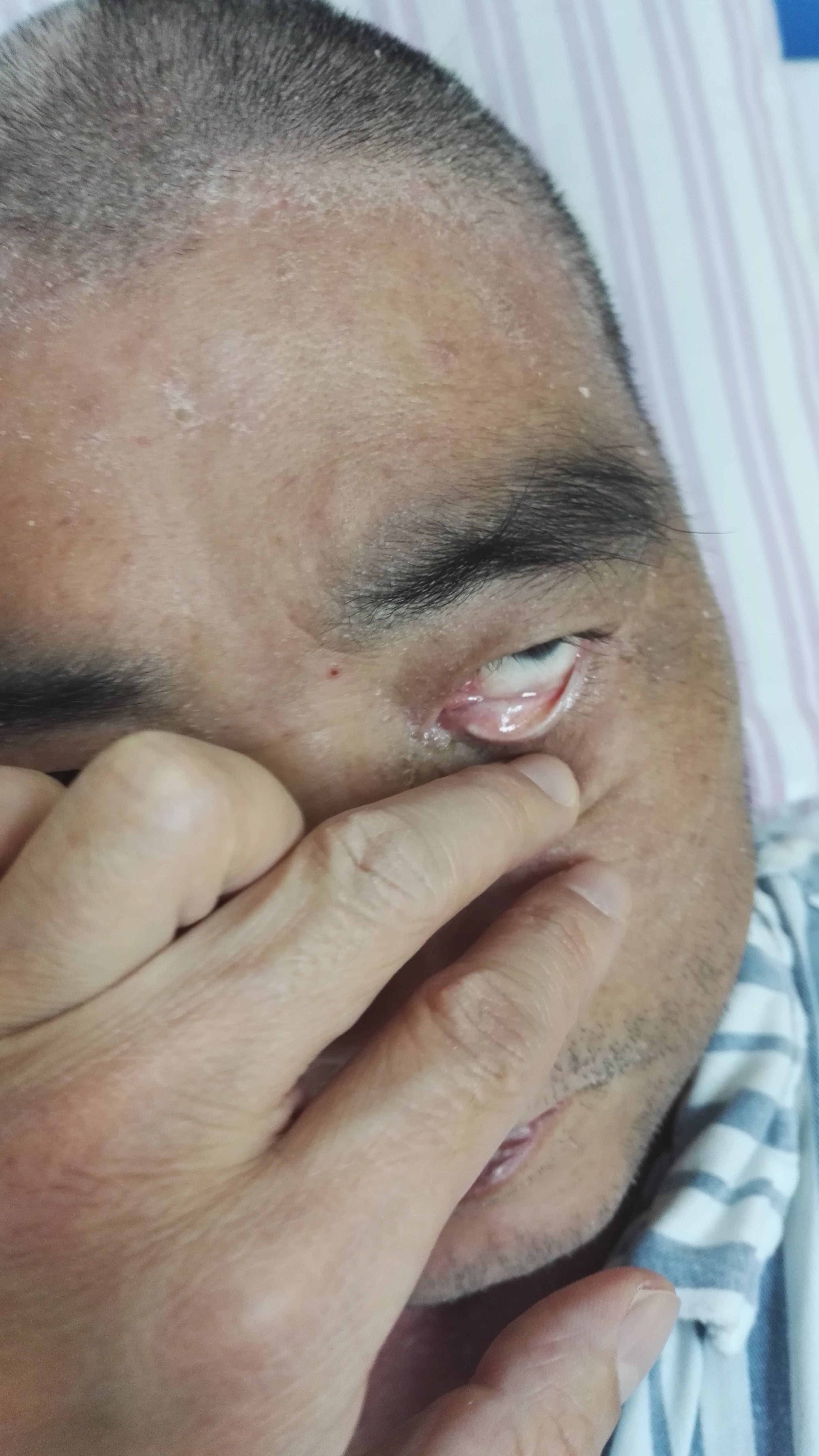 红皮病型银屑病高热1例 - 好大夫在线