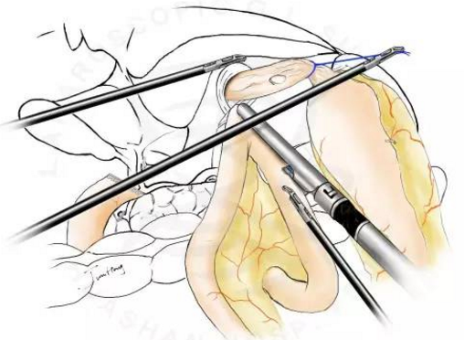 圖解splt全腹腔鏡全胃切除後重建的新方式