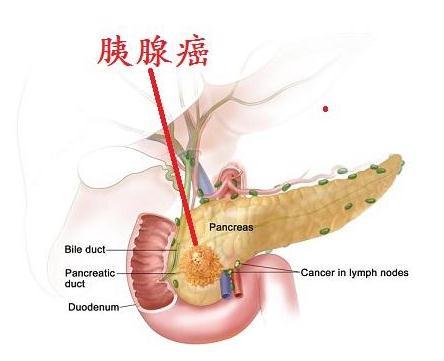 胰腺癌早期图片