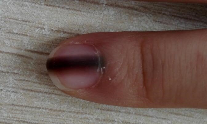 常见纵向黑甲有哪些?