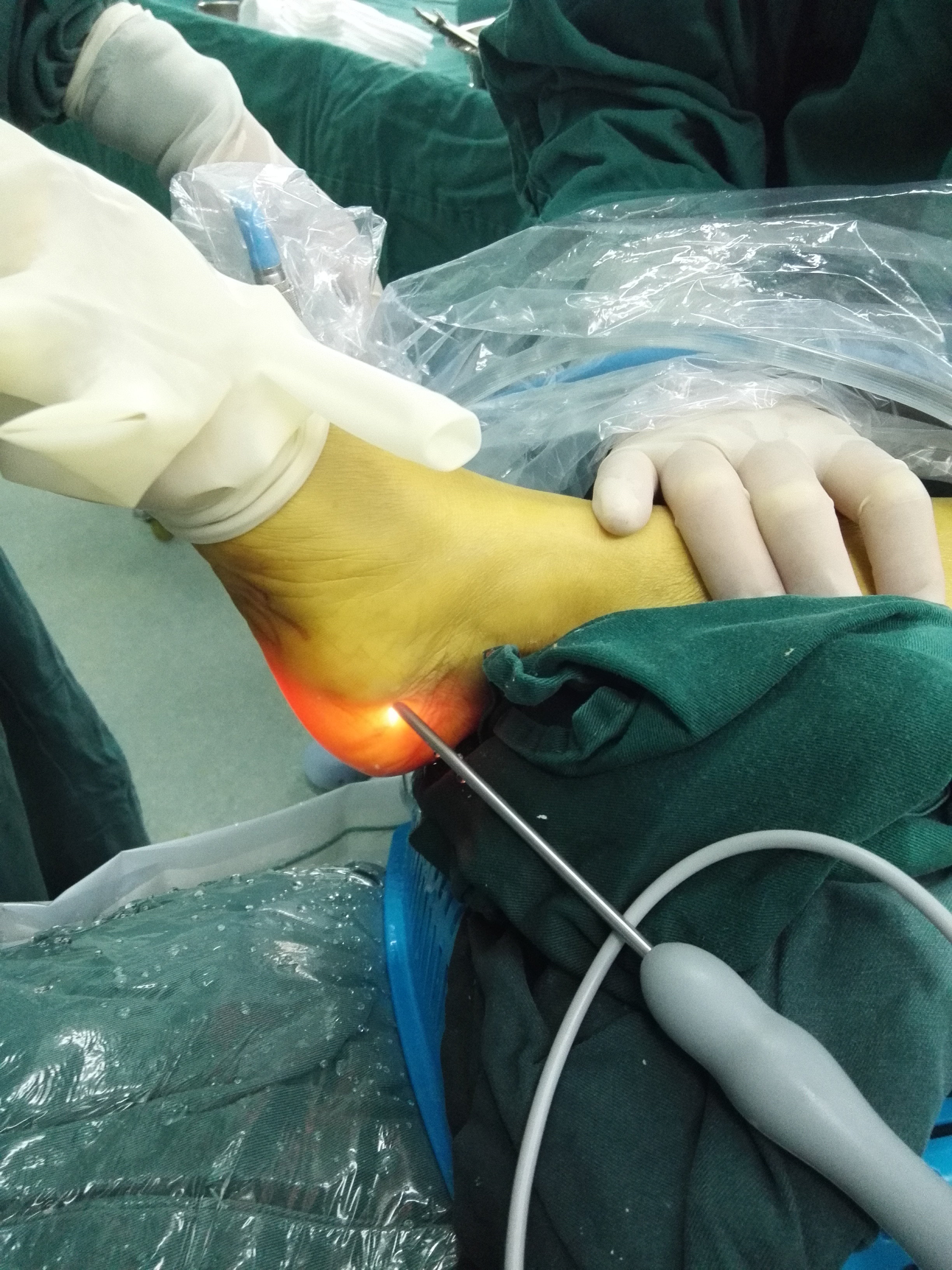 术中暴露骨刺骨刺切除后镜下像术后摄片