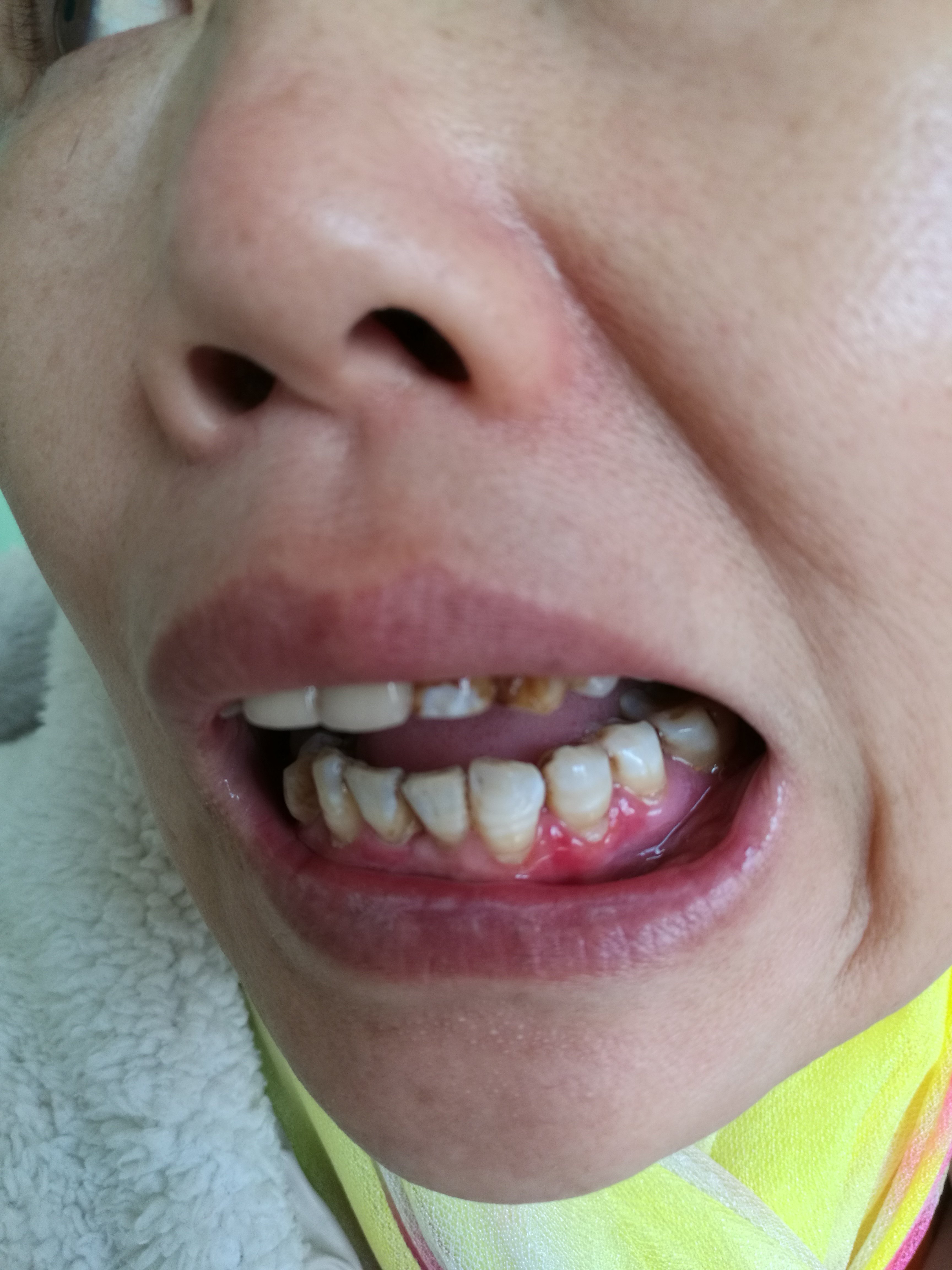 牙龈扁平苔藓症状图片图片