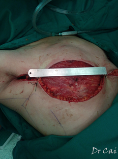 乳腺癌手术切口设计图图片