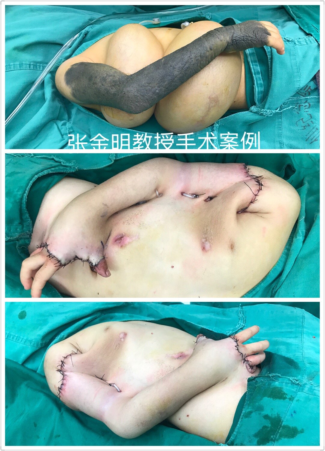 右上肢巨大黑痣(兽皮痣,巨痣) - 好大夫在线