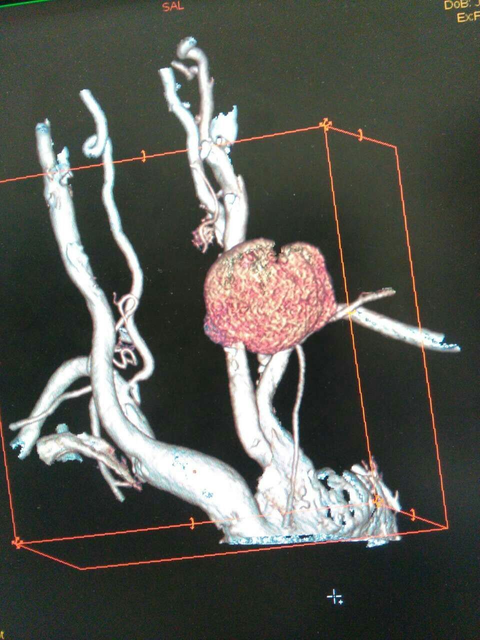 颈部动脉血管瘤 - 好大夫在线