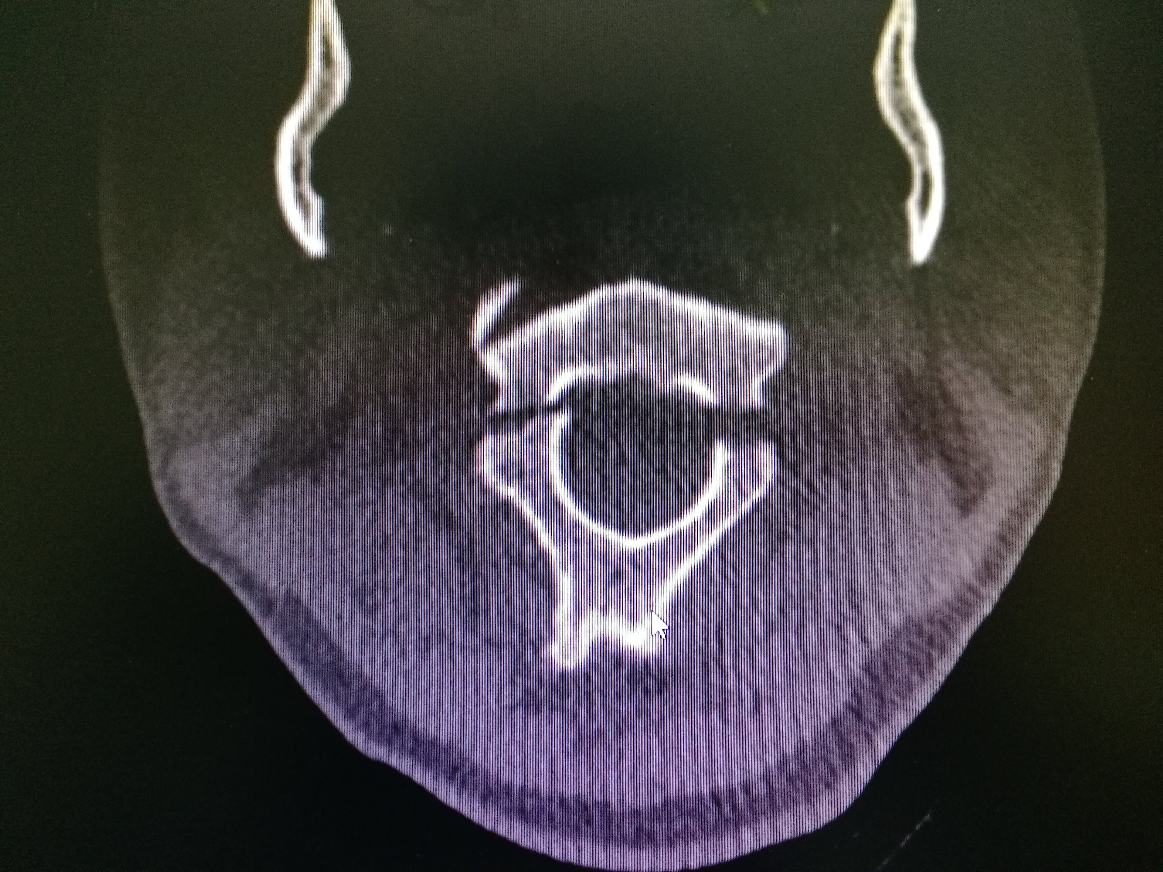 第2节颈椎椎弓骨折 