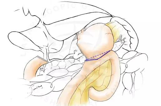 手绘图解各种三角吻合