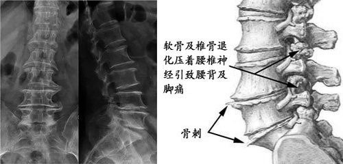 脊柱关节突绞索图片