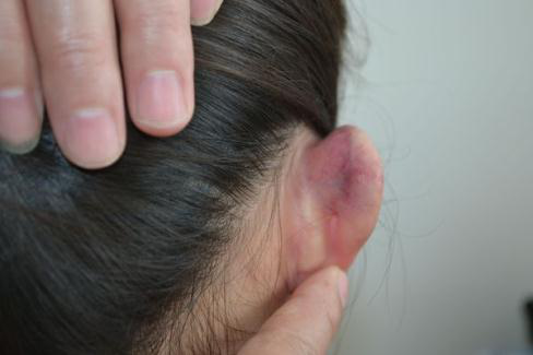 外耳瘢痕疙瘩术后压迫治疗图片(衣服夹) 