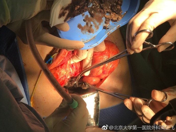 急性重症胰腺炎感染坏死性胰腺炎胰腺脓肿的手术救治录