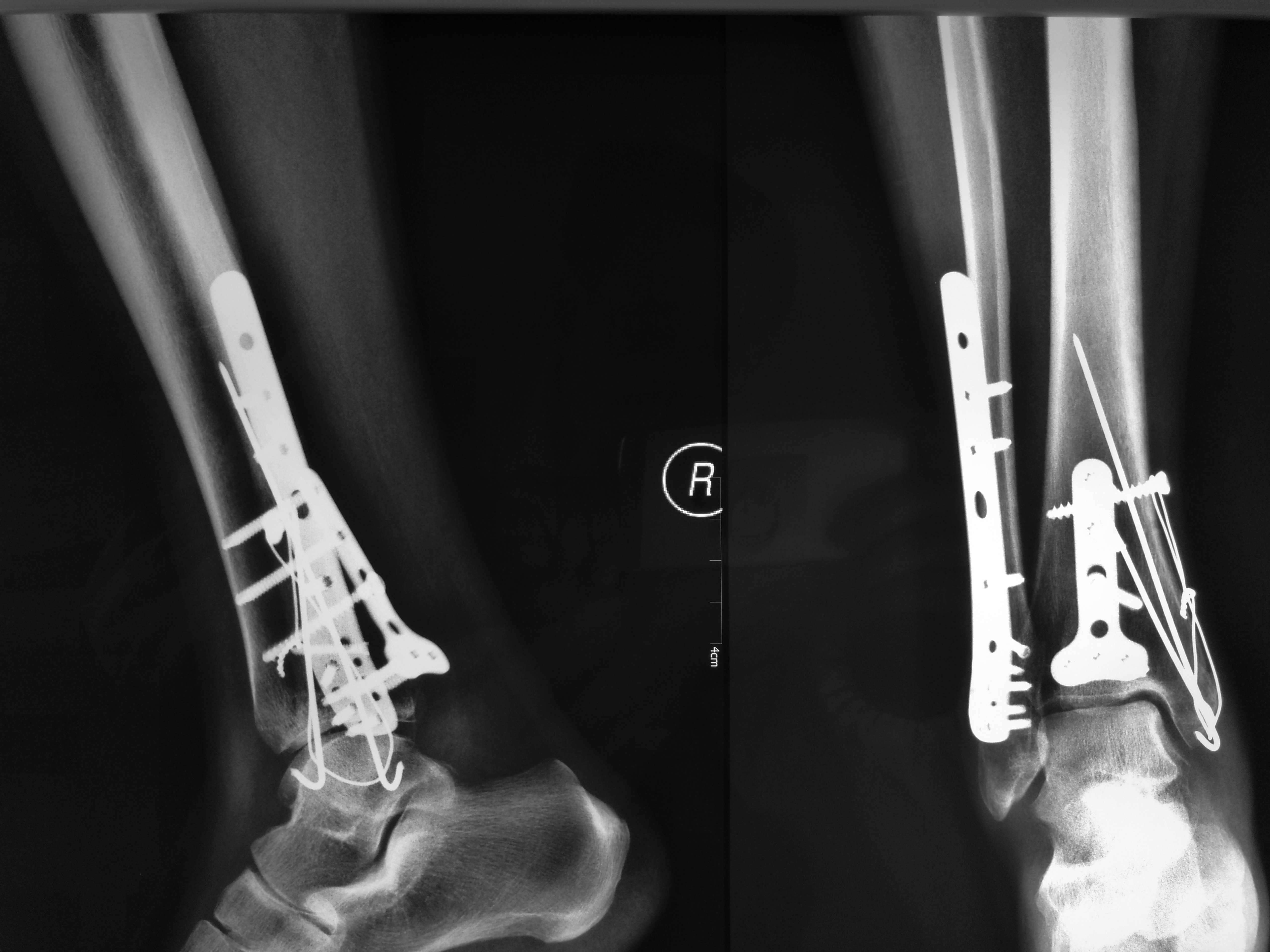 三踝骨折 - 好大夫在线