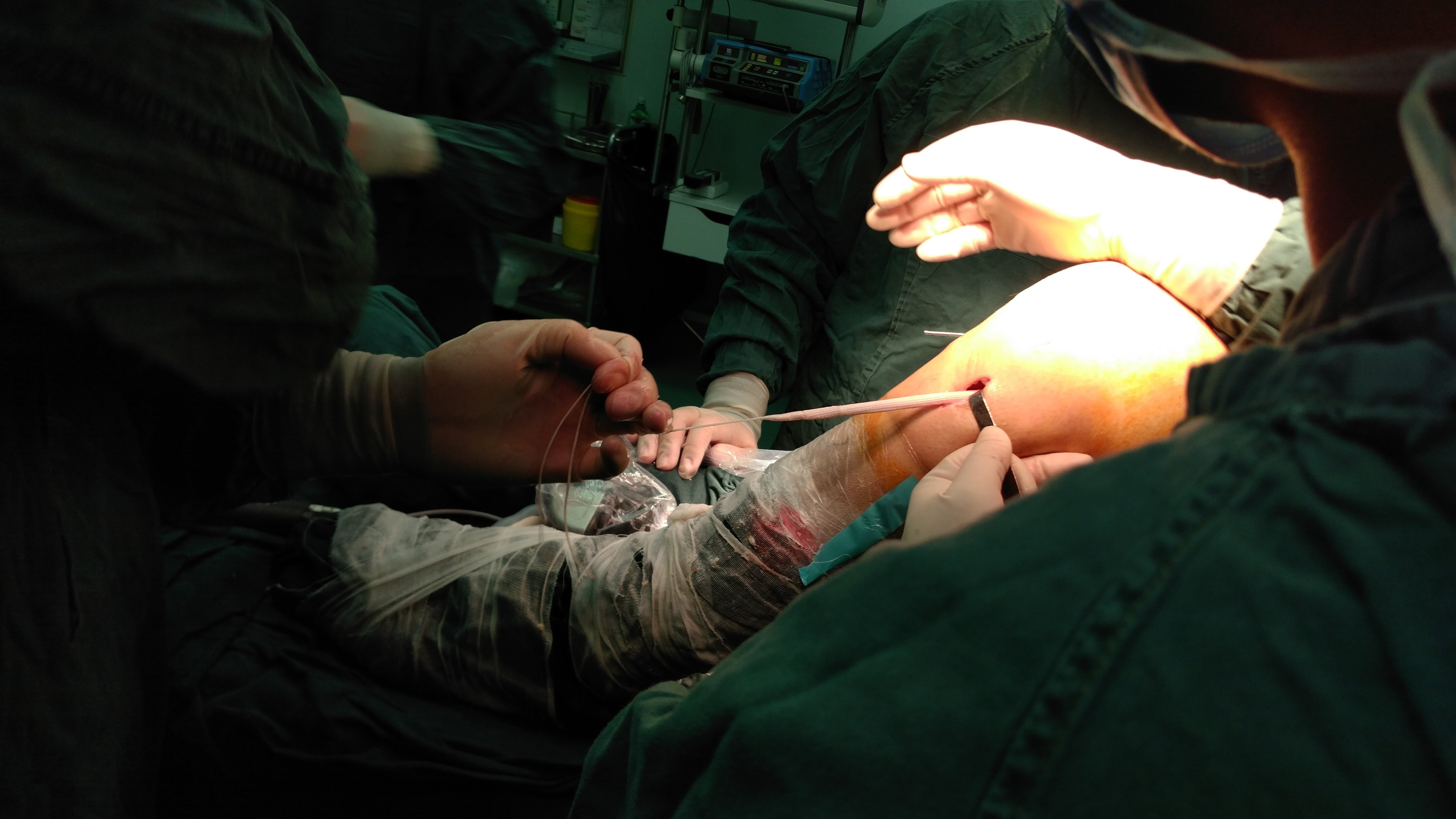 全镜下膝关节前交叉自体韧带,后交叉lars韧带重建术. - 好大夫在线