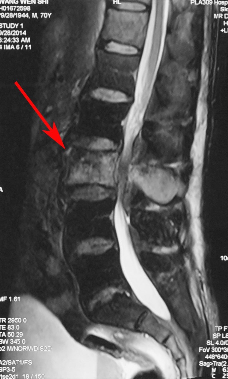 胸椎脊膜瘤图片