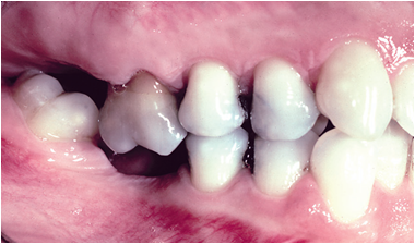 如不及时修复可引起以下不良后果: 1, 缺牙区对应的牙齿伸长