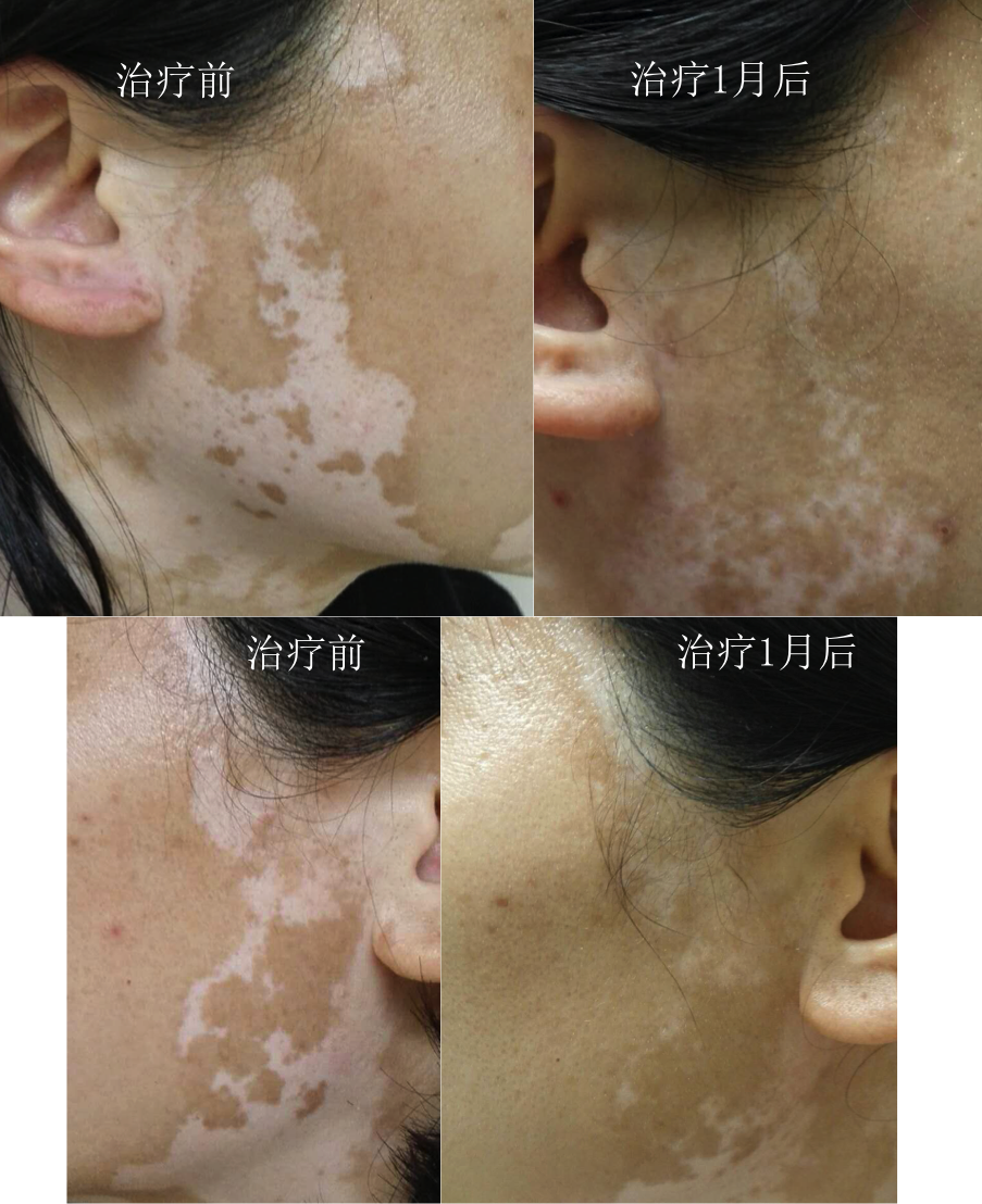 长期慢性白癜风患者是否能进一步缓解? - 好大夫在线