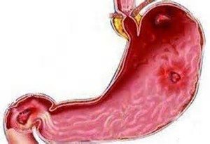 阿斯匹林、氯吡格雷和消化道出血那些事